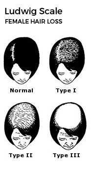 Ludwig Scale: Female Hair Loss Treatment Baltimore Washington Arlington Patuxent River