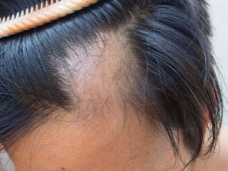 maryland alopecia areata hair loss treatment