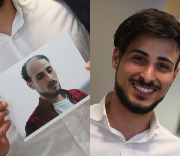 mens hair loss restoration baltimore mechanicsville annapolis maryland