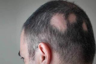 Alopecia Areata Hair Loss