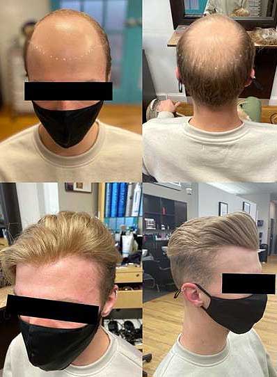 Non-Surgical Male Hair Replacement - Baltimore, Maryland