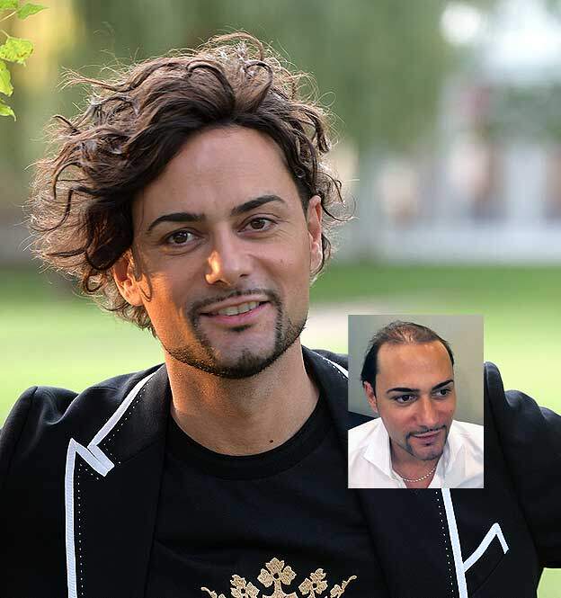 CRLAB CNC Mens Hair Replacement Washington Baltimore Mechanicsville Maryland