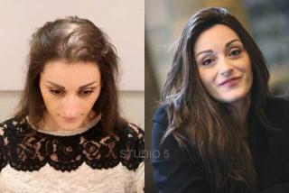 female hair restoration baltimore mechanicsville patuxent river maryland