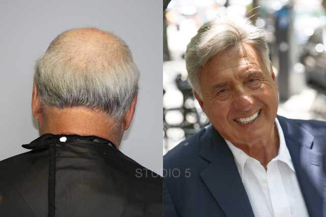 Men's Hair Restoration Results - Baltimore Annapolis Mechanicsville MD