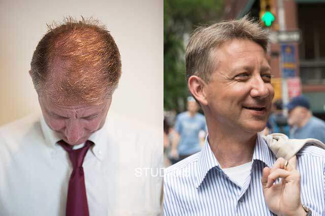Men's Hair Restoration Results - Baltimore Annapolis Mechanicsville MD