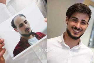 CRLAB CNC Men's Non-Surgical Hair Replacement Full Coverage