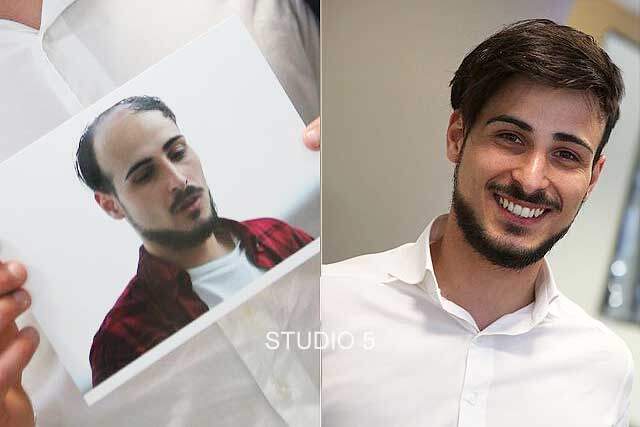 Men's Hair Restoration Results - Baltimore Annapolis Mechanicsville MD