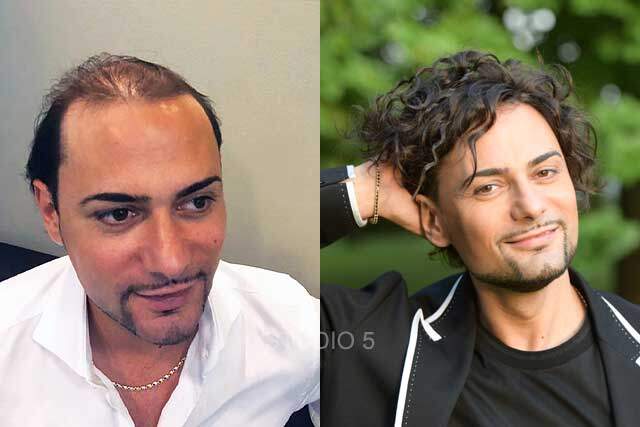 Men's Hair Restoration Results - Baltimore Annapolis Mechanicsville MD