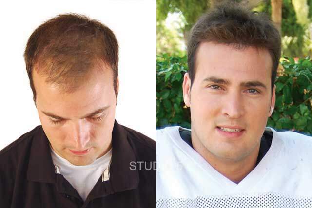 Men's Hair Restoration Results - Baltimore Annapolis Mechanicsville MD