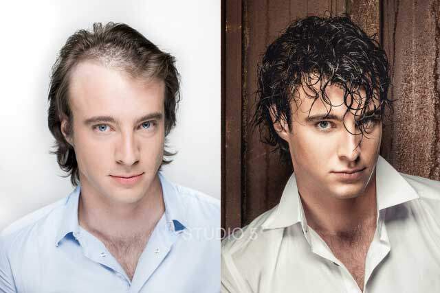 Men's Hair Restoration Results - Baltimore Annapolis Mechanicsville MD