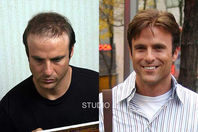 Men's Hair Restoration Results - Baltimore Annapolis Mechanicsville MD