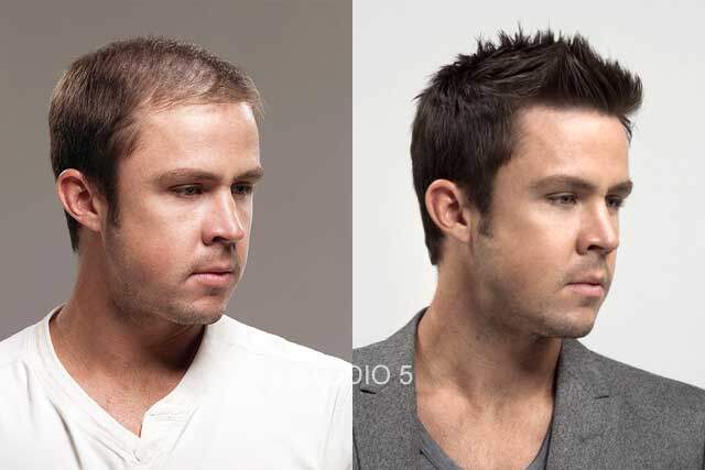 Men's Hair Restoration Results - Baltimore Annapolis Mechanicsville MD