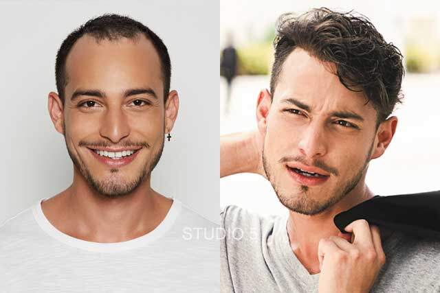 Men's Hair Restoration Results - Baltimore Annapolis Mechanicsville MD
