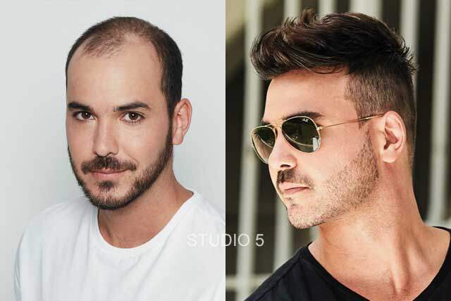 Men's Hair Restoration Results - Baltimore Annapolis Mechanicsville MD