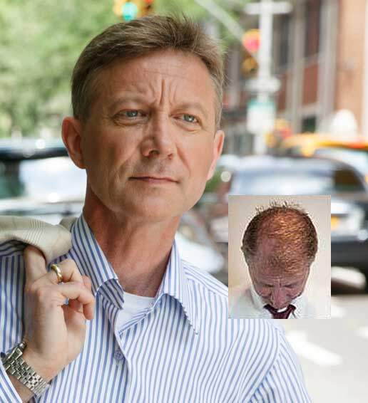 mens-hair-replacement-hair-loss-treatment-calvert-county-maryland mens hair replacement hair loss treatment calvert county maryland