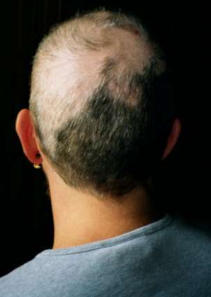 trichotillomania hair salon wigs stylist baltimore mechanicsville maryland