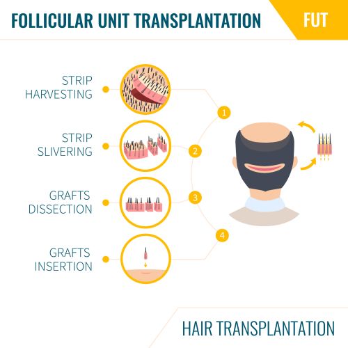 why hair transplants wont work for everyone